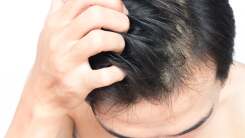 How to Exfoliate Your Scalp to Stay Flake-Free This Winter